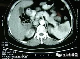 【病例】脾脏组织胞浆菌性肉芽肿1例CT 【病例】脾脏组织胞浆菌性肉芽肿1例CT