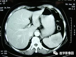 【病例】脾脏组织胞浆菌性肉芽肿1例CT 【病例】脾脏组织胞浆菌性肉芽肿1例CT