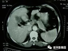 【病例】脾脏组织胞浆菌性肉芽肿1例CT 【病例】脾脏组织胞浆菌性肉芽肿1例CT