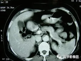 【病例】脾脏组织胞浆菌性肉芽肿1例CT 【病例】脾脏组织胞浆菌性肉芽肿1例CT