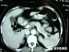 【病例】脾脏组织胞浆菌性肉芽肿1例CT 【病例】脾脏组织胞浆菌性肉芽肿1例CT