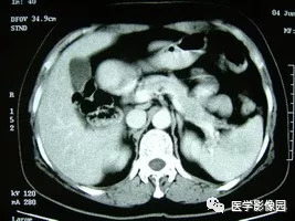 【病例】脾脏组织胞浆菌性肉芽肿1例CT 【病例】脾脏组织胞浆菌性肉芽肿1例CT