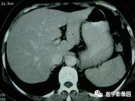 【病例】脾脏组织胞浆菌性肉芽肿1例CT 【病例】脾脏组织胞浆菌性肉芽肿1例CT