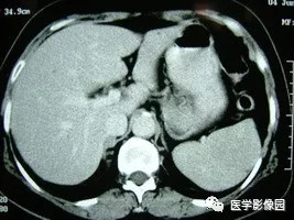 【病例】脾脏组织胞浆菌性肉芽肿1例CT 【病例】脾脏组织胞浆菌性肉芽肿1例CT