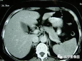 【病例】脾脏组织胞浆菌性肉芽肿1例CT 【病例】脾脏组织胞浆菌性肉芽肿1例CT
