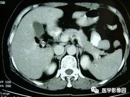 【病例】脾脏组织胞浆菌性肉芽肿1例CT 【病例】脾脏组织胞浆菌性肉芽肿1例CT