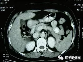 【病例】脾脏组织胞浆菌性肉芽肿1例CT 【病例】脾脏组织胞浆菌性肉芽肿1例CT