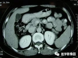 【病例】脾脏组织胞浆菌性肉芽肿1例CT 【病例】脾脏组织胞浆菌性肉芽肿1例CT