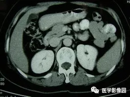 【病例】脾脏组织胞浆菌性肉芽肿1例CT 【病例】脾脏组织胞浆菌性肉芽肿1例CT