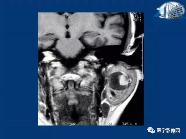 【PPT】腮腺病变的影像诊断与分析思路