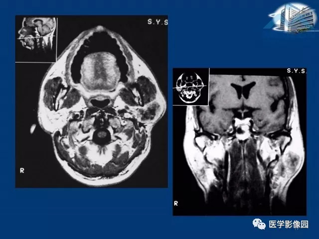 【PPT】腮腺病变的影像诊断与分析思路