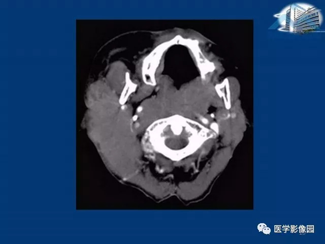 【PPT】腮腺病变的影像诊断与分析思路