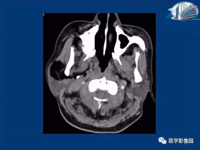 【PPT】腮腺病变的影像诊断与分析思路