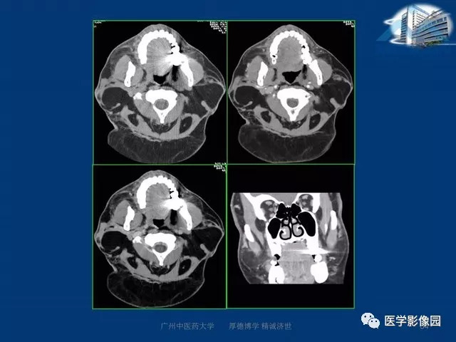 【PPT】腮腺病变的影像诊断与分析思路
