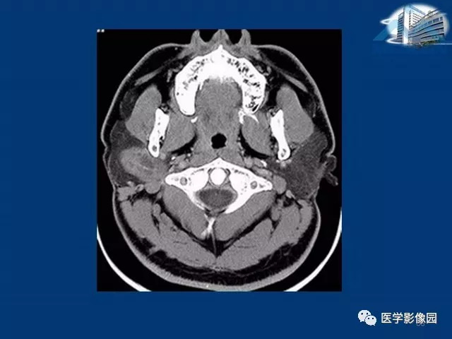 【PPT】腮腺病变的影像诊断与分析思路