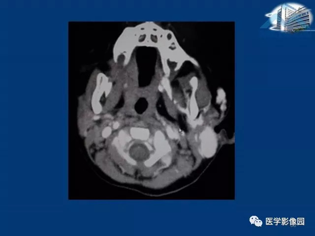 【PPT】腮腺病变的影像诊断与分析思路