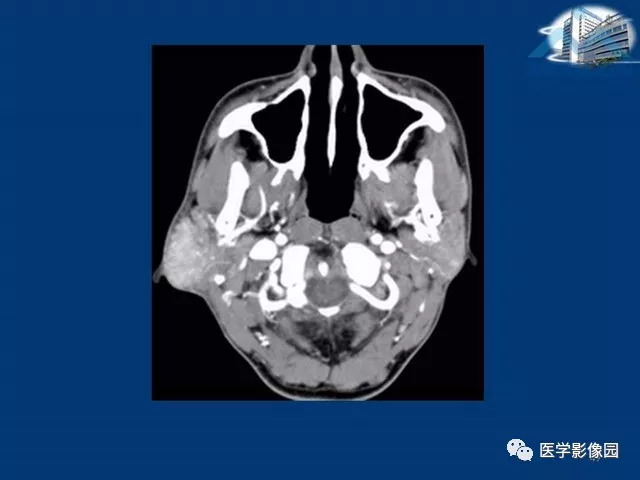 【PPT】腮腺病变的影像诊断与分析思路