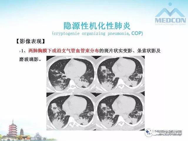 【PPT】隐源性机化性肺炎的影像学特点