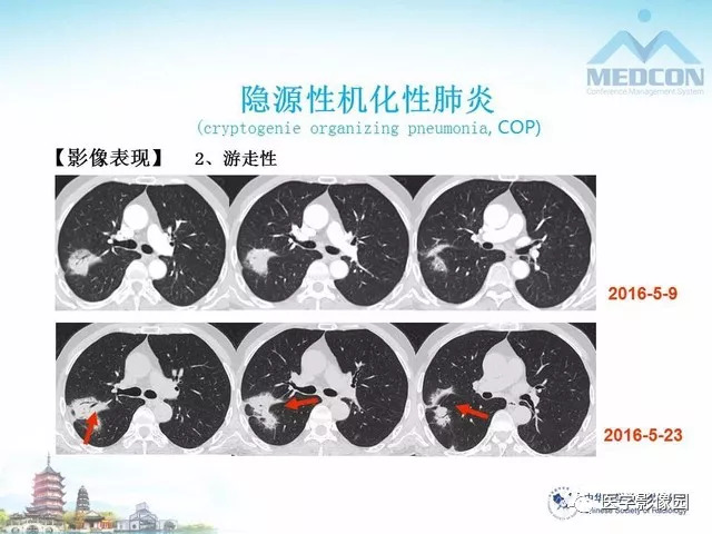 【PPT】隐源性机化性肺炎的影像学特点