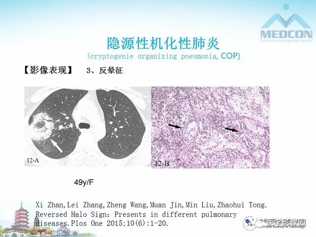 【PPT】隐源性机化性肺炎的影像学特点