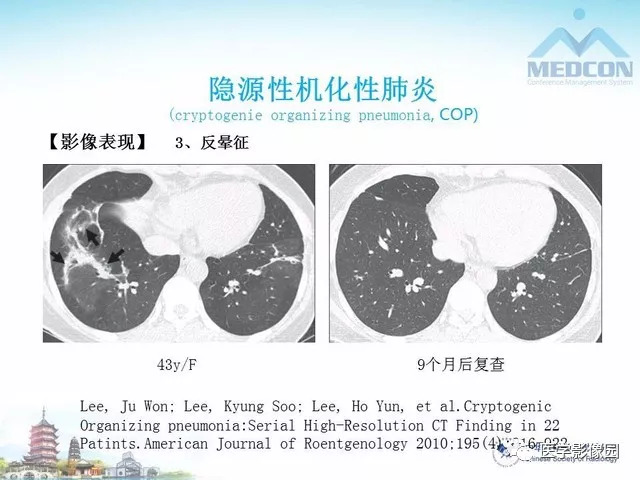 【PPT】隐源性机化性肺炎的影像学特点
