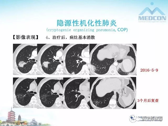 【PPT】隐源性机化性肺炎的影像学特点