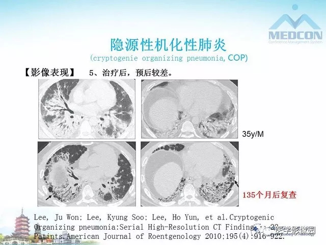 【PPT】隐源性机化性肺炎的影像学特点