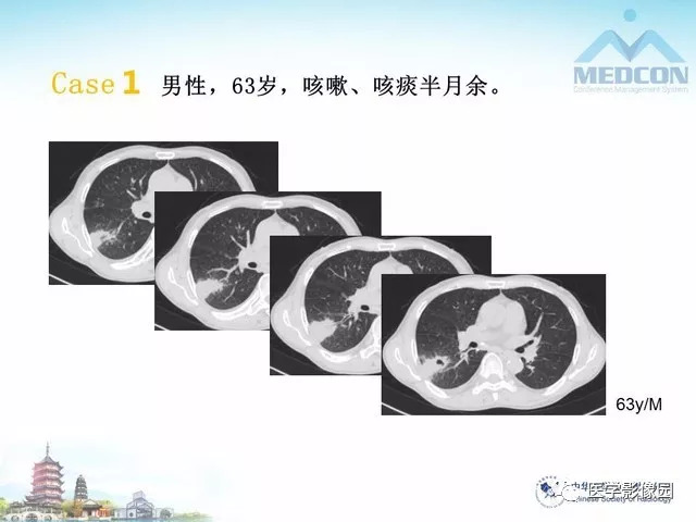 【PPT】隐源性机化性肺炎的影像学特点