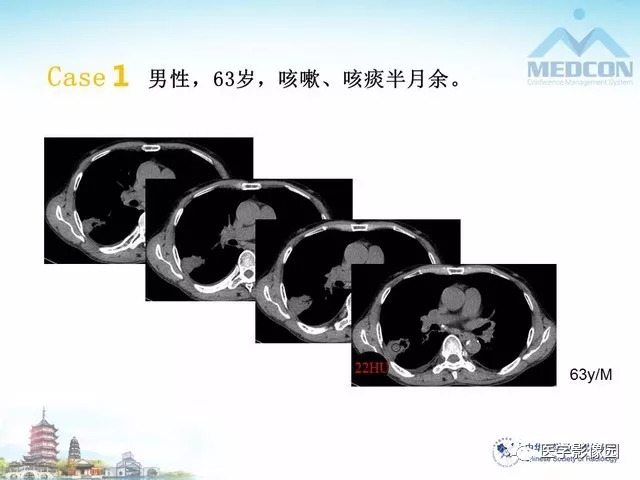 【PPT】隐源性机化性肺炎的影像学特点