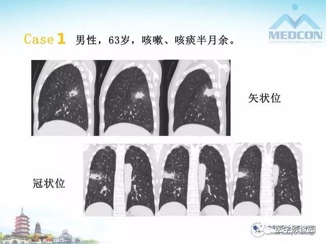 【PPT】隐源性机化性肺炎的影像学特点