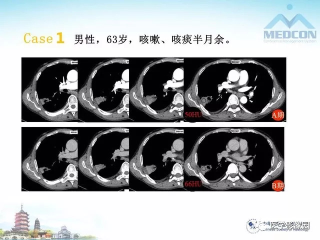 【PPT】隐源性机化性肺炎的影像学特点