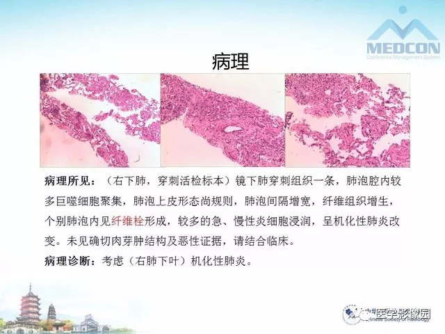 【PPT】隐源性机化性肺炎的影像学特点