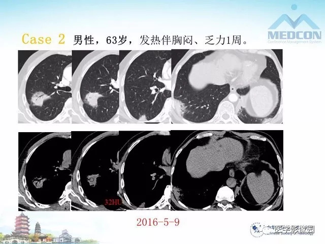 【PPT】隐源性机化性肺炎的影像学特点