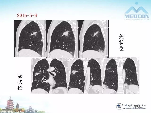 【PPT】隐源性机化性肺炎的影像学特点