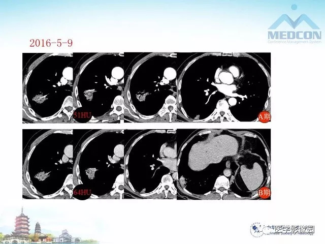 【PPT】隐源性机化性肺炎的影像学特点