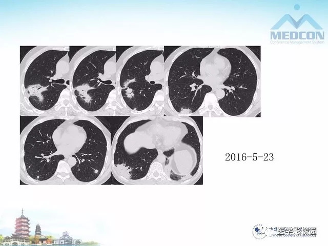 【PPT】隐源性机化性肺炎的影像学特点