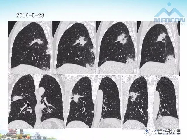 【PPT】隐源性机化性肺炎的影像学特点