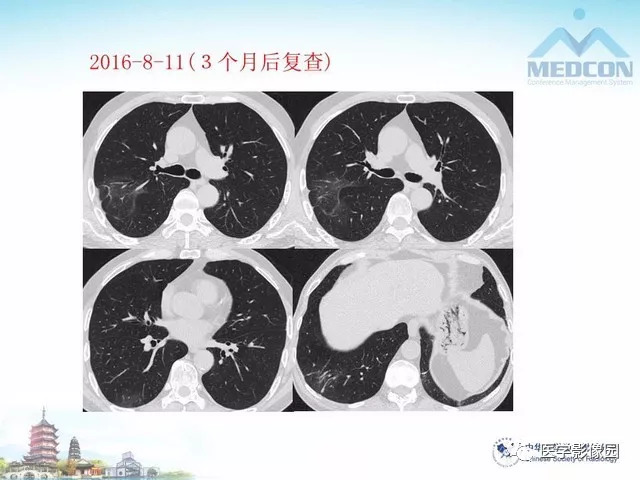 【PPT】隐源性机化性肺炎的影像学特点
