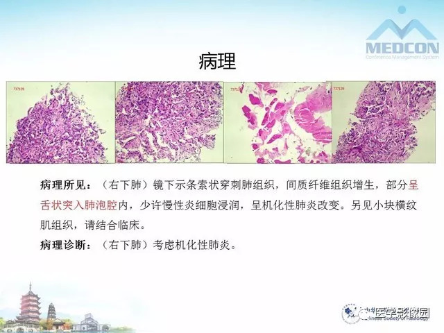 【PPT】隐源性机化性肺炎的影像学特点