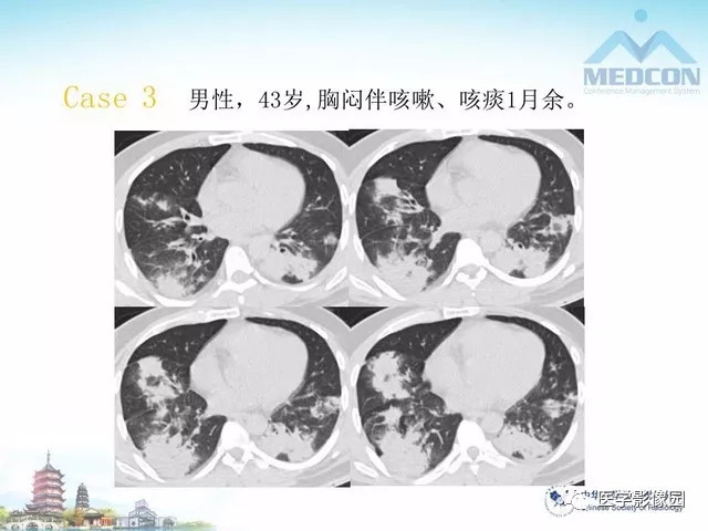 【PPT】隐源性机化性肺炎的影像学特点