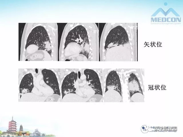 【PPT】隐源性机化性肺炎的影像学特点