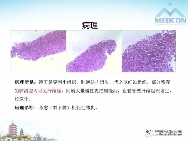 【PPT】隐源性机化性肺炎的影像学特点