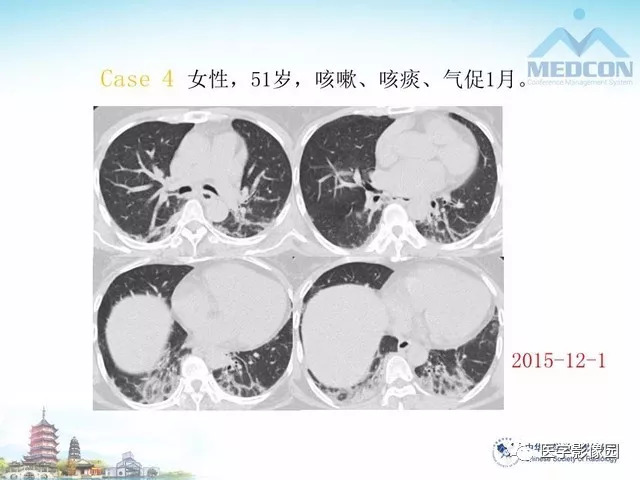 【PPT】隐源性机化性肺炎的影像学特点