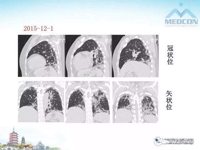 【PPT】隐源性机化性肺炎的影像学特点