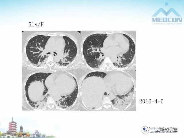 【PPT】隐源性机化性肺炎的影像学特点