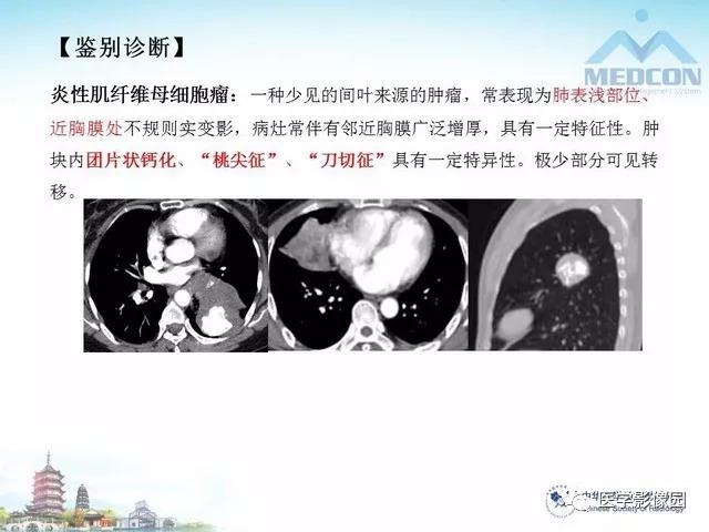 【PPT】隐源性机化性肺炎的影像学特点