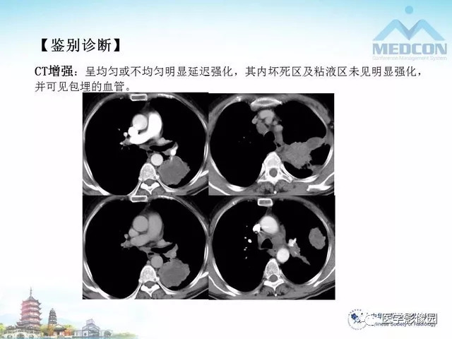 【PPT】隐源性机化性肺炎的影像学特点