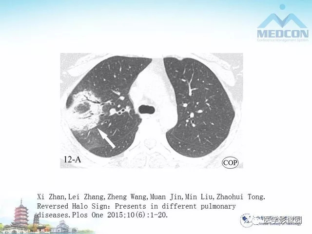【PPT】隐源性机化性肺炎的影像学特点