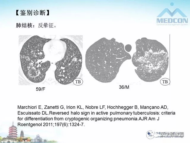 【PPT】隐源性机化性肺炎的影像学特点