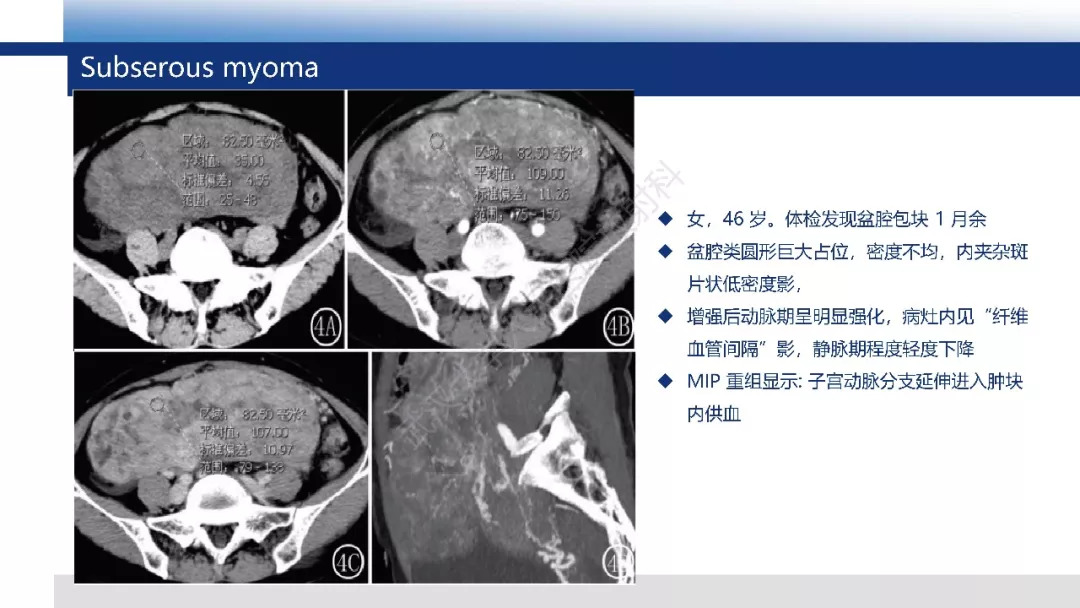 【PPT】卵巢无性细胞瘤影像诊断